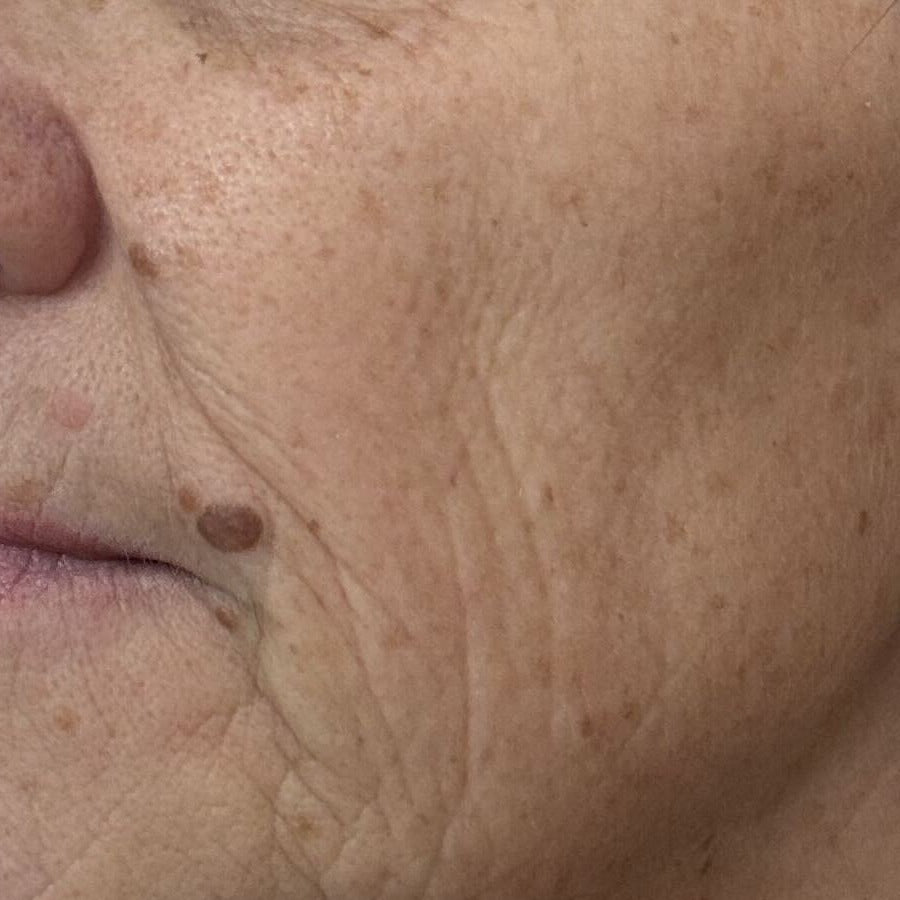 LEFT CHEEK before