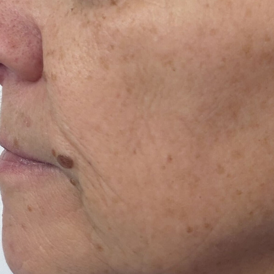 LEFT CHEEK after