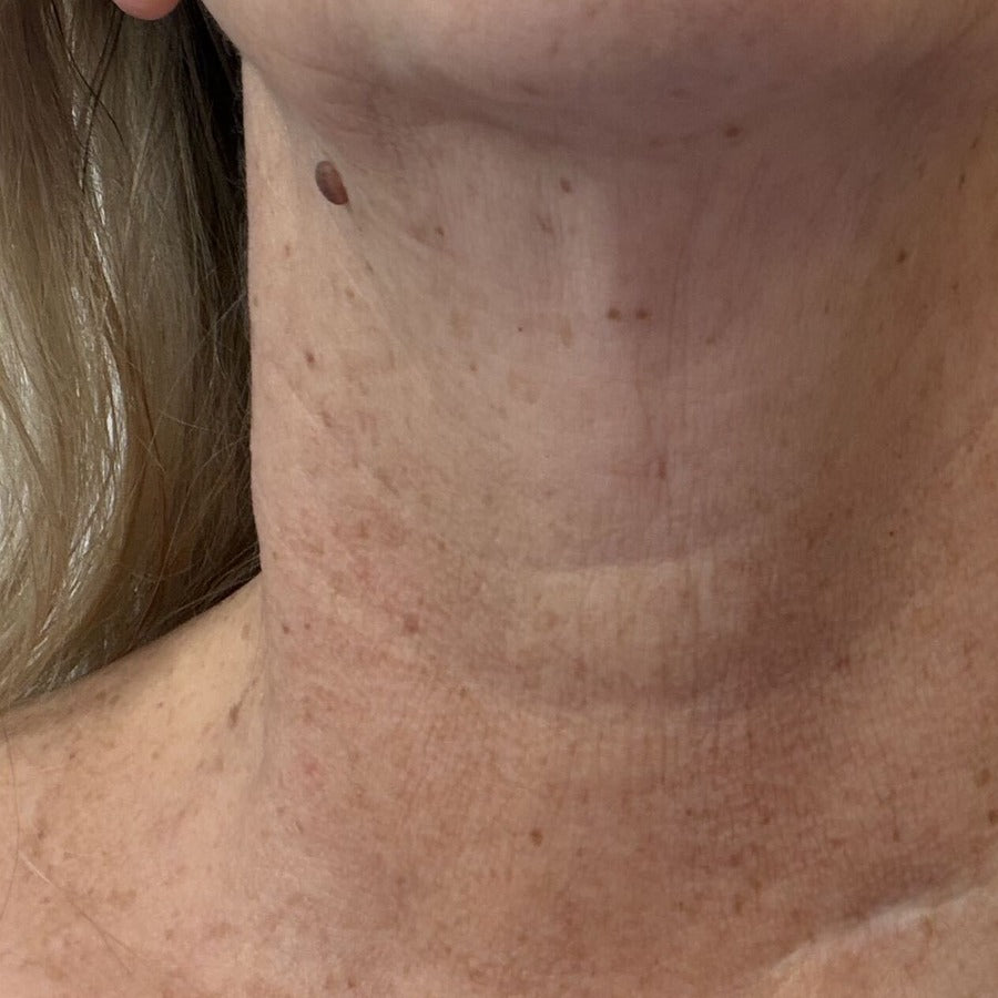 NECK after